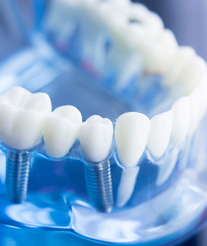 Zahnimplantate